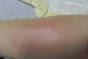 Moulage - Bruise - Bobbie Merica