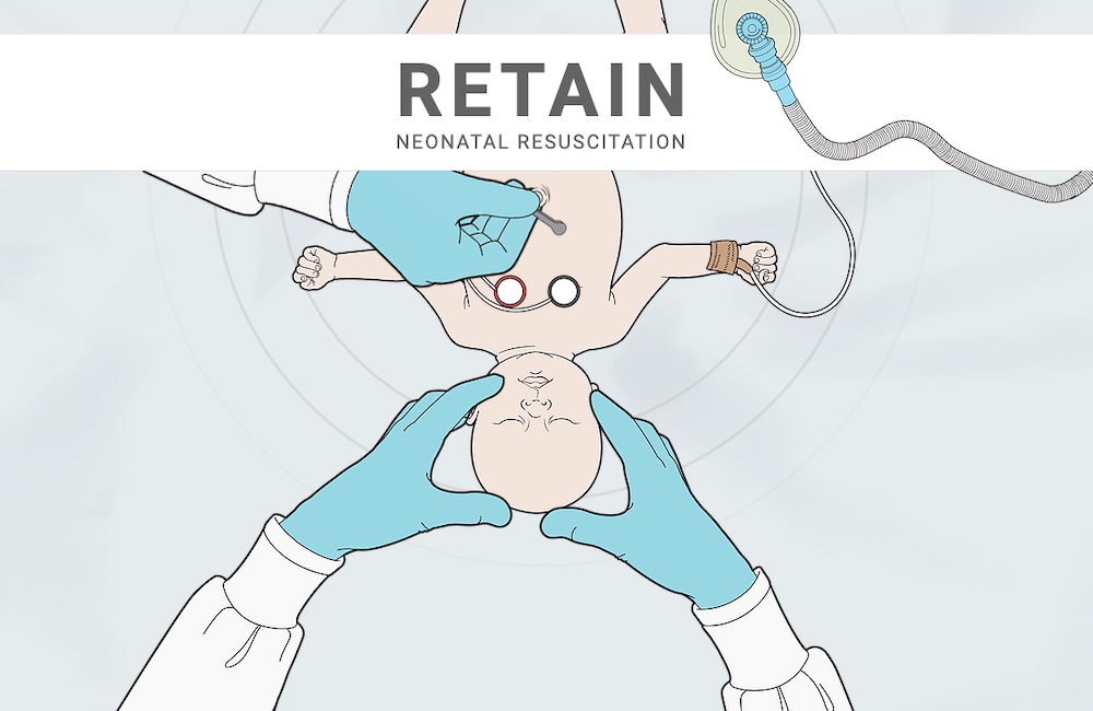 Canadian Simulation Educators Create RETAIN Board Game to Train Neonatal Resuscitation