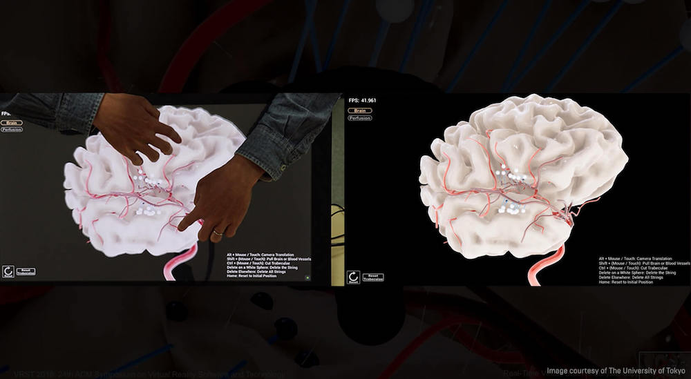 Neurosurgeons Practice with New Real Time Patient Brain Simulator