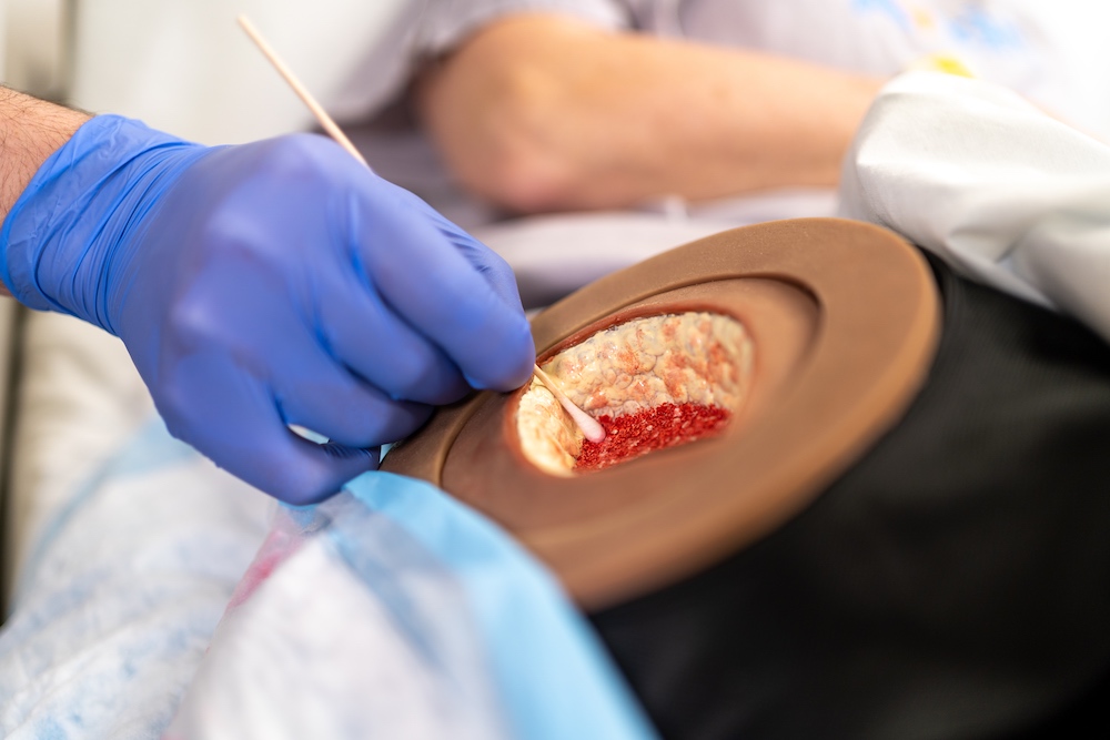 *NEW* Avkin Avwound Wearable Simulator Enhances Wound Care Education